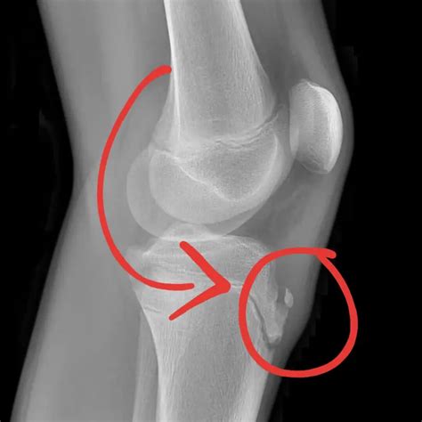 Mt Kuring Gai Health Osgood Schlatter Disease