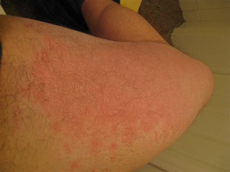 Why Do I Have A Rash On The Back Of My Thigh Kulturaupice