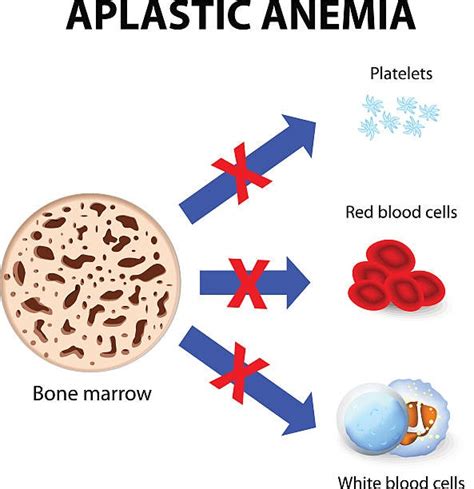 Navigating Aplastic Anemia Understanding Diagnosis And Treatment