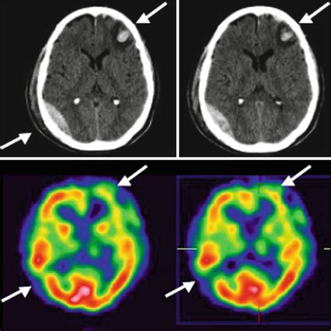 Traumatic Brain Injury Nuclear Medicine Neuroimaging Radiology Key