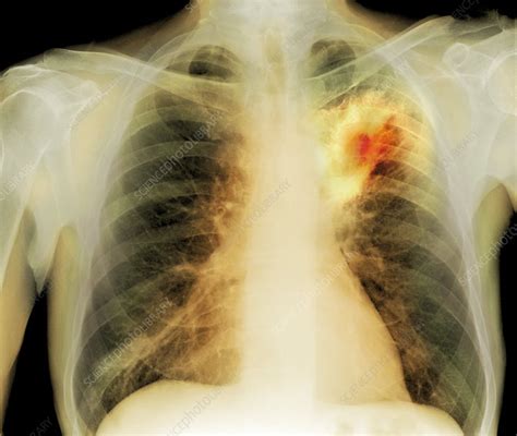 Lung Abscess X Ray Stock Image C0073676 Science Photo Library