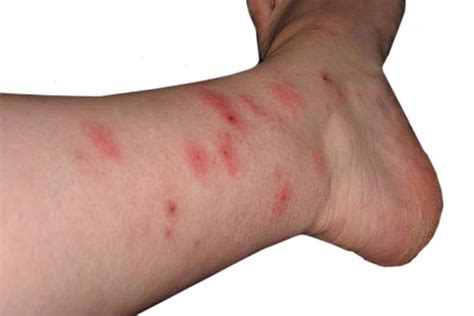 How Long Do Bed Bug Bites Last Take To Appear Go Away