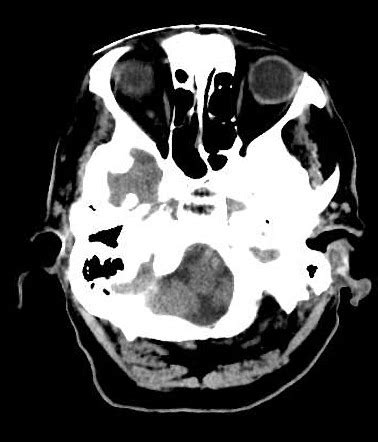 Hemorrhagic Stroke Basal Ganglia Radiology Case Radiopaedia Org