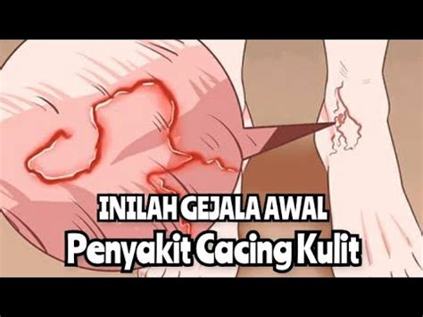 INILAH GEJALA PENYAKIT LARVA CACING PADA KULIT MANUSIA YouTube