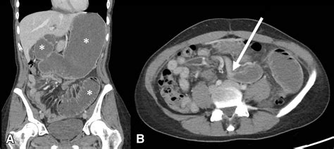 A Case Report Of Adhesional Small Bowel Obstruction Caused By