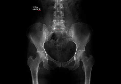 Spina Bifida Uci Pediatric Urology