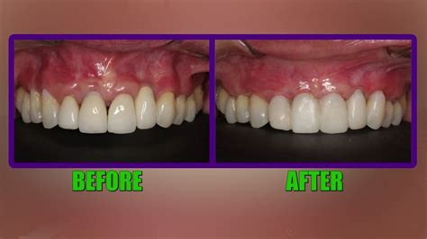 New Procedure Fixes Gum Recession Without Cutting Stitching