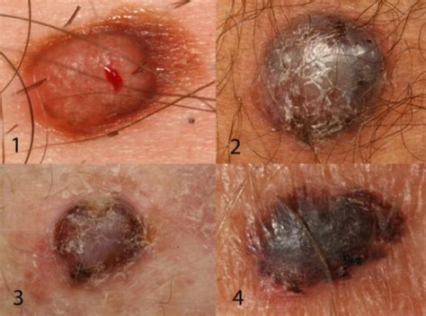 Nodular Melanoma What You Should Know About This Killer Scary Symptoms