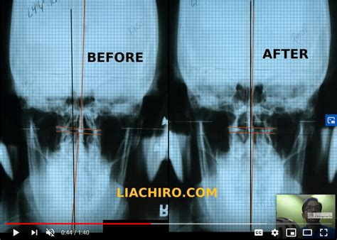 Upper Cervical Chiropractic Cases From Dr Zachary Ward Chiropractor
