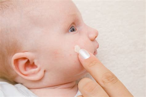 For i didn't know that it will harm my baby girl, but it did: Woman Finger Applying Medical Ointment On Infant Cheek Red ...