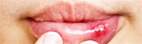 Canker Sores Causes Symptoms Treatment And Prevention