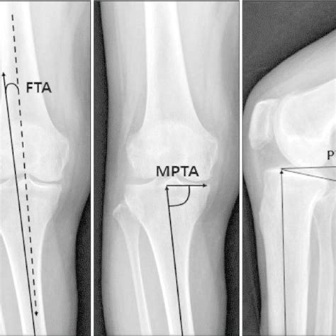 Hip Knee Ankle Angle Hkaa Measurement Method And Correction Of Varus