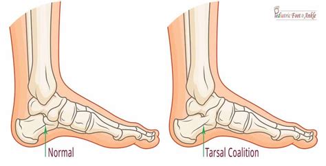 Tarsal Coalitions In Children Pediatric Foot And Ankle