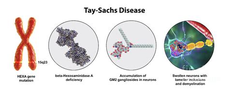 Tay Sachs Disease Photograph By Kateryna Kon Science Photo Library Fine Art America