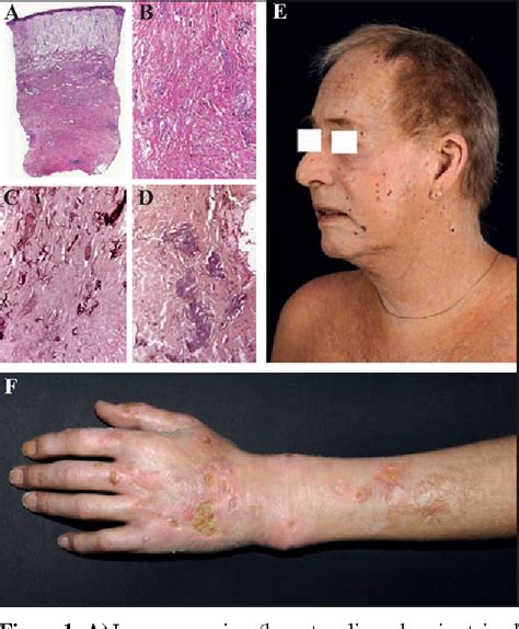 Figure 1 From A Rare Case Of Mucinous Carcinoma Of The Skin With