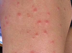 Sand Fly Bites Treatment Pictures Symptoms Healing Time How Long