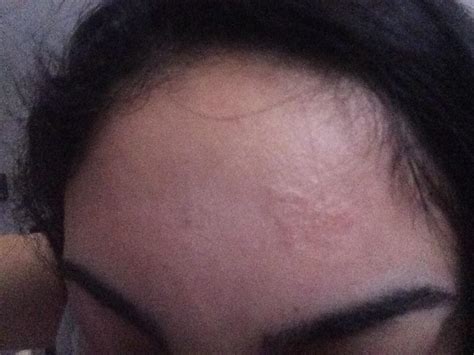 What Is This Patch Of Bumps On My Forehead Hypertrophic Raised Scars Acne Org