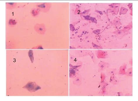 Figure 1 From Nuclear And Cytoplasmic Changes In Buccal Mucosal Cells