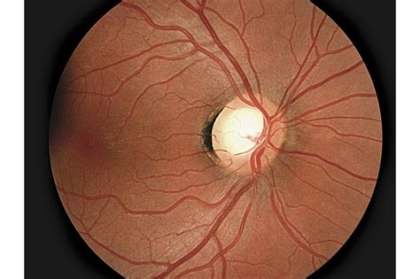 Central Visual Field Loss In Glaucoma Worse After Optic Disc Hemorrhage