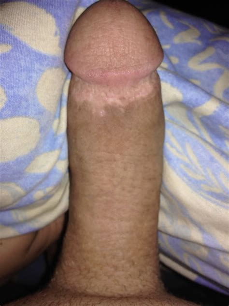 After Circumcision New Pics Xhamster