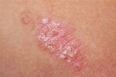 Eczema needs to be diagnosed by a doctor but can. 6 Reasons Your Butt Is So Red And Itchy Right Now - WSTale.com
