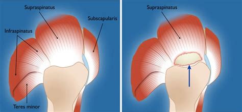 Most of the time it is accompanied with another rotator cuff muscle tear. Rotator Cuff Tears - OrthoInfo - AAOS