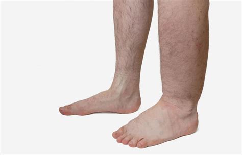 Causes Of Leg And Ankle Swelling