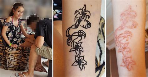 Girls Temporary Black Henna Tattoo Turns Into Oozing Burn That Could