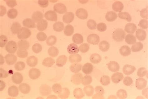 Kostenlose Bild Plasmodium Malariae Trophozoite Klein Fleck