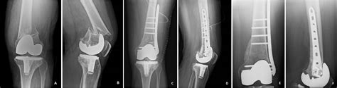 Periprosthetic Distal Femoral Fractures After Total Knee Replacement