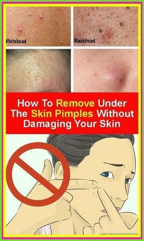 How To Get Away How Do I Get Pimples Under The Skin Beauty Tips And