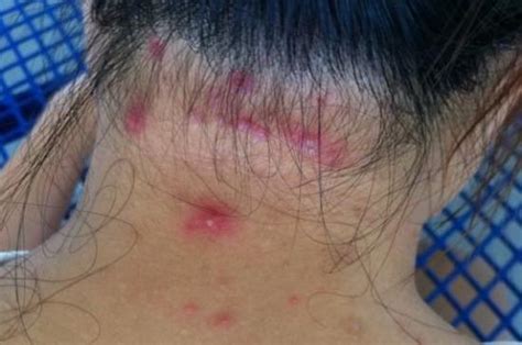 Scalp Infections Causes Symptoms Treatments And Pictures
