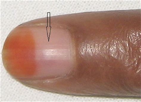 Nail Avulsion Indications And Methods Surgical Nail Avulsion