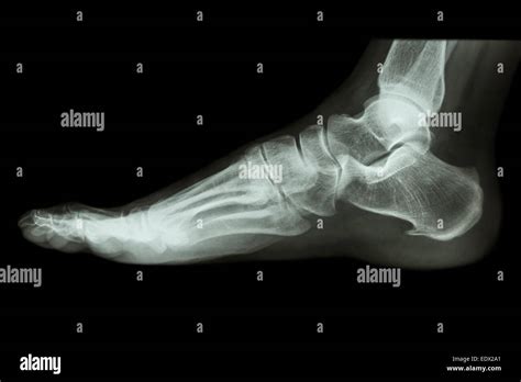 Lateral Foot Radiograph Anatomy My Xxx Hot Girl