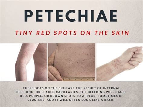 Tiny Red Spots On Skin Petechiae Causes And Treatments Dots Red