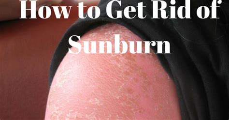 How To Get Rid Of Sunburn Health Tips 101