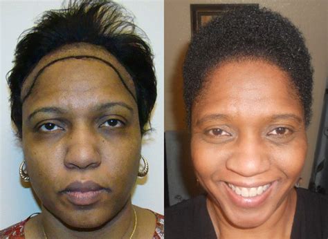 African caribbean, african american, black british etc) have specific differences to caucasian or asian hair, which makes it very important that any hair transplant clinic has experience and understanding of these. African American Woman patients page - Dr. Brett Bolton