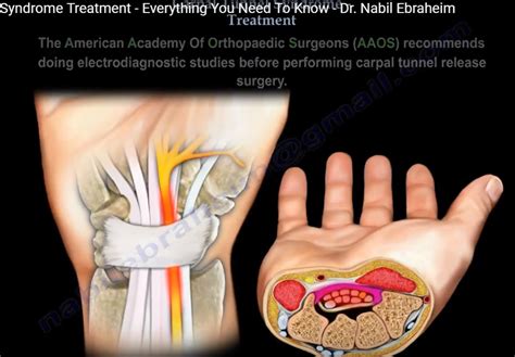 Carpal Tunnel Syndrome Explained With Surgical Steps —