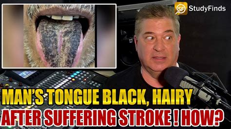 Effects Of A Stroke Mans Tongue Becomes Black Hairy Youtube