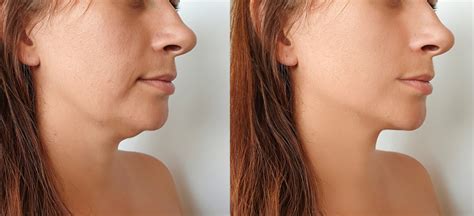 Chin Fat Removal Marlow Face And Body