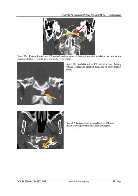 Imaging In Craniovertebral Junction Cvj Abnormalities