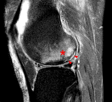 Subchondral Fracture Femoral Head