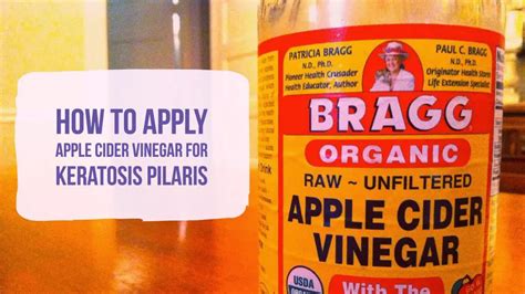 How To Apply Apple Cider Vinegar For Keratosis Pilaris Wellnessguide