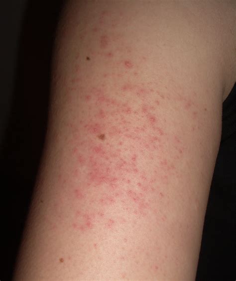 How To Treat Dots Bumps And Red Spots On Skin Red Spots On Skin Hq