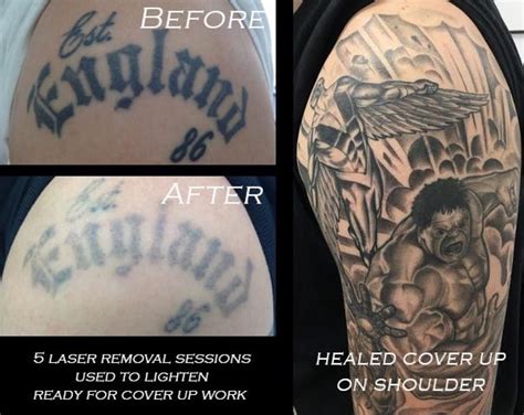 Healed Example Of A Coverup Tattoo After Few Laser Removal Treatments
