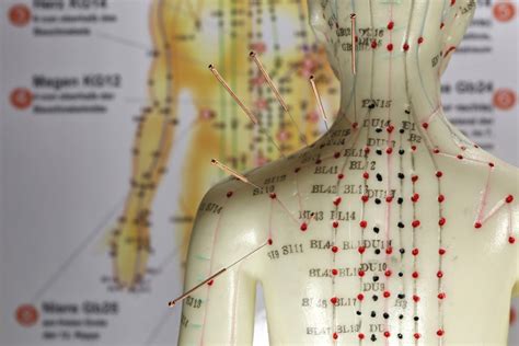 Why You Should Do Medical Acupuncture For Pain Management Blogs