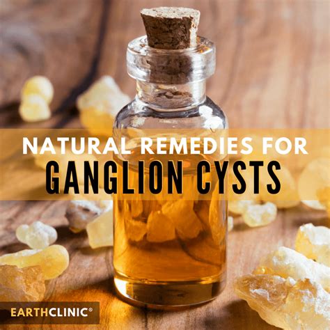Ganglion Cyst Natural Remedies And Pain Relief