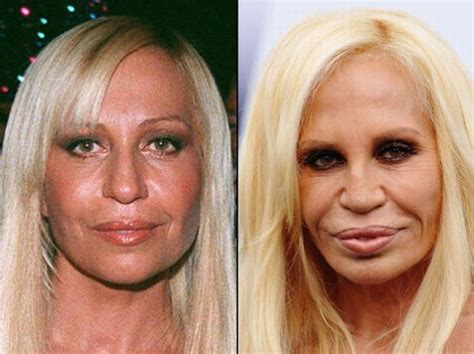 22 Celebrities Before And After Plastic Surgery In 2021 Donatella