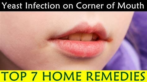 Yeast Infection On Corner Of Mouth Causes Symptoms Prevention Home Remedies Youtube