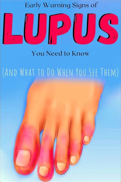 13 Early Warning Signs Of Lupus You Need To Know And What To Do The